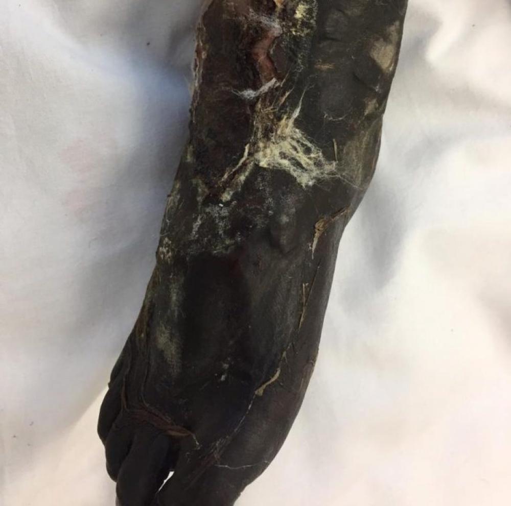 Malhada: imprensa local se une para ajudar família a comprar prótese para criança amputada