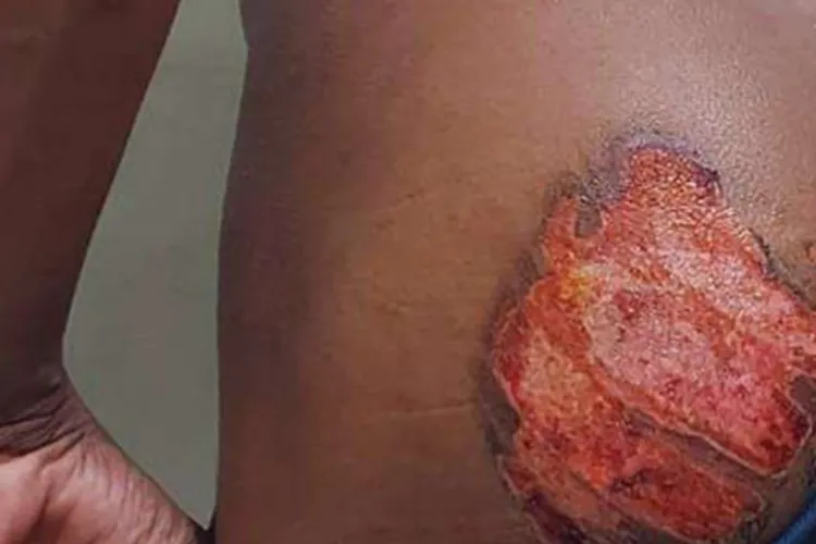 Irmãos são presos por queimar jovem negro com ferro quente em Livramento 