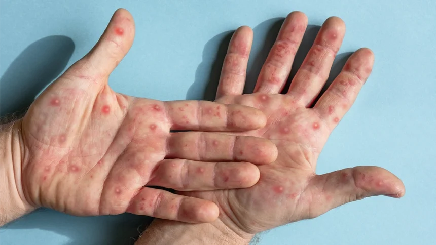 Caso de Mpox é confirmado em Vitória da Conquista