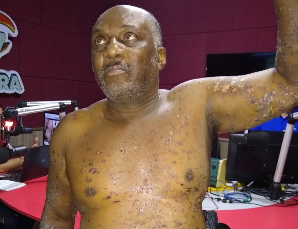 Guanambi: morre homem que buscava descobrir tratamento para doença que o deixava a com o corpo coberto por bolhas 
