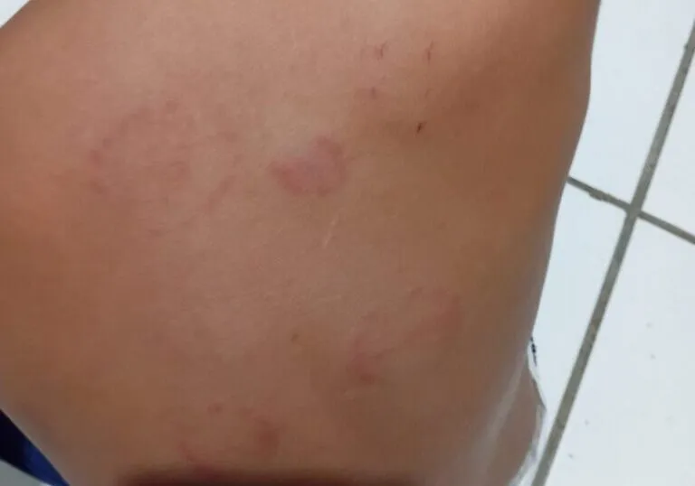 Criança de três anos é mordida nove vezes por colega dentro de creche em Guanambi