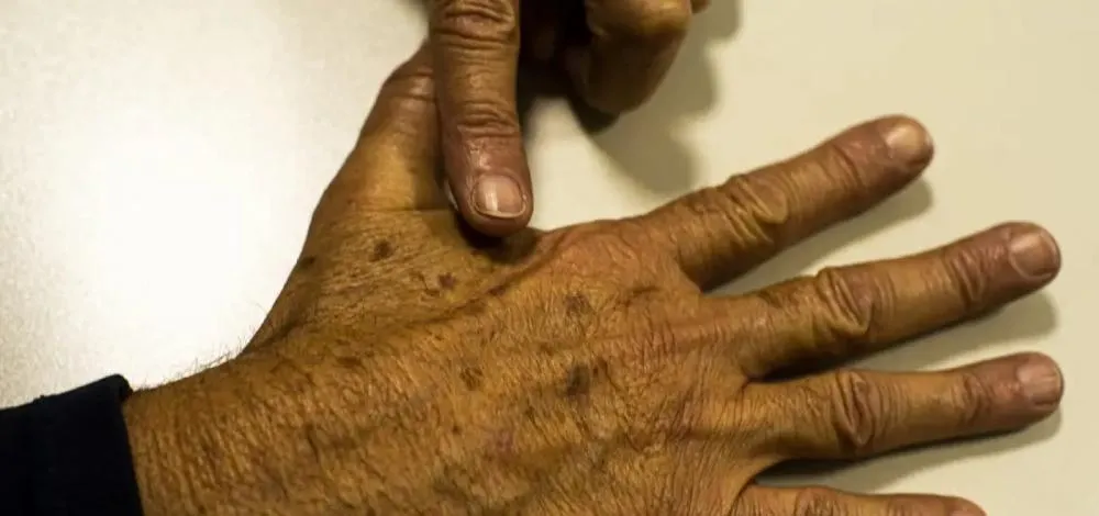 Casos de câncer de pele saltam de 4 mil para mais de 72 mil em 10 anos no Brasil