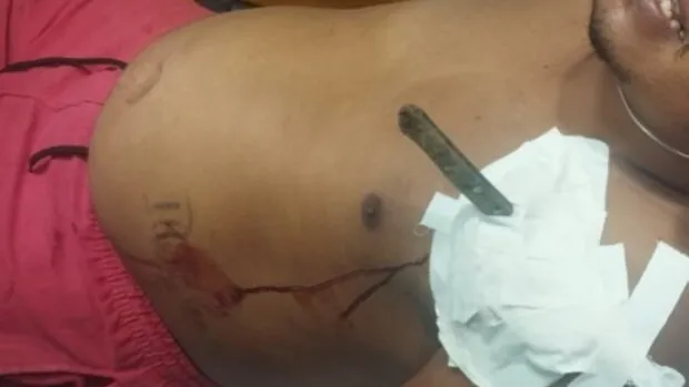 Perdoa a facada? Jovem fica com faca cravada no peito após briga com ex em Gongogi