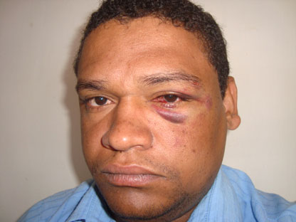 Livramento: Radialista é agredido em festa