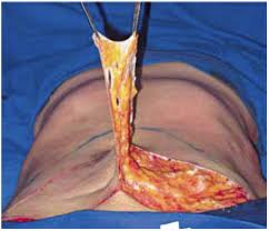 Técnica cirúrgica facilita remoção de pele de quem perdeu muito peso