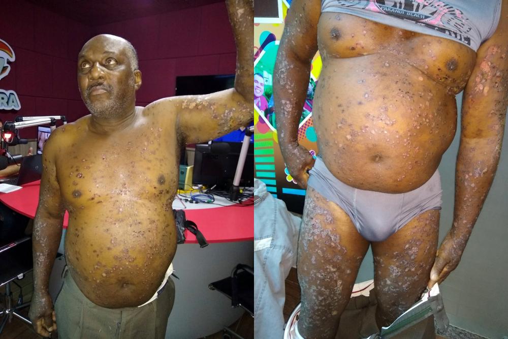 Guanambi: Homem sofre com doença misteriosa e pede ajuda 