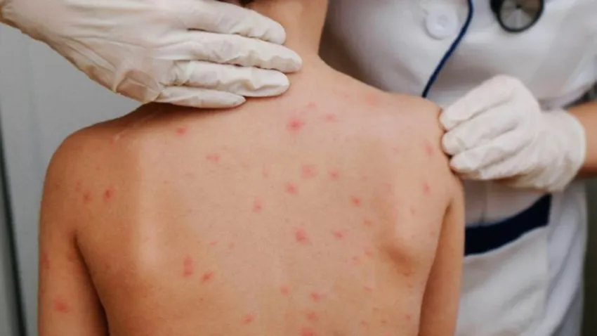 Surto de sarna é confirmado em Guaratinga; mais de 30 casos já foram registrados