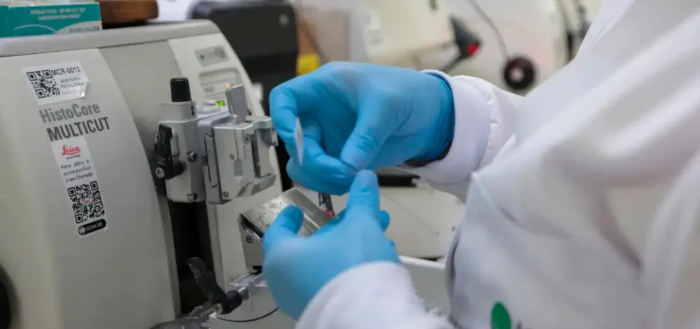 SUS vai oferecer novo tratamento para pacientes com leucemia mieloide aguda