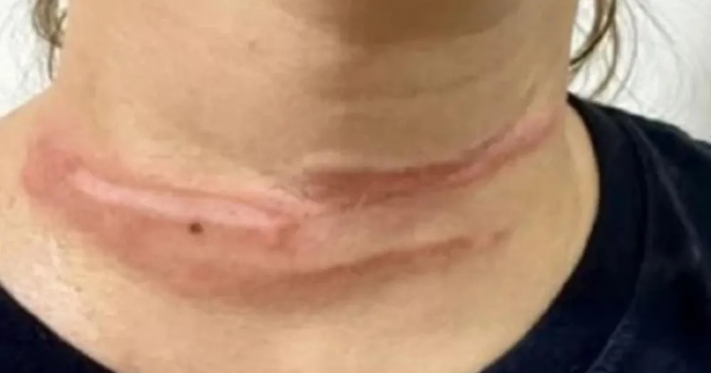 Motociclista é atingida por fio no pescoço e escapa sem ferimentos graves em Livramento