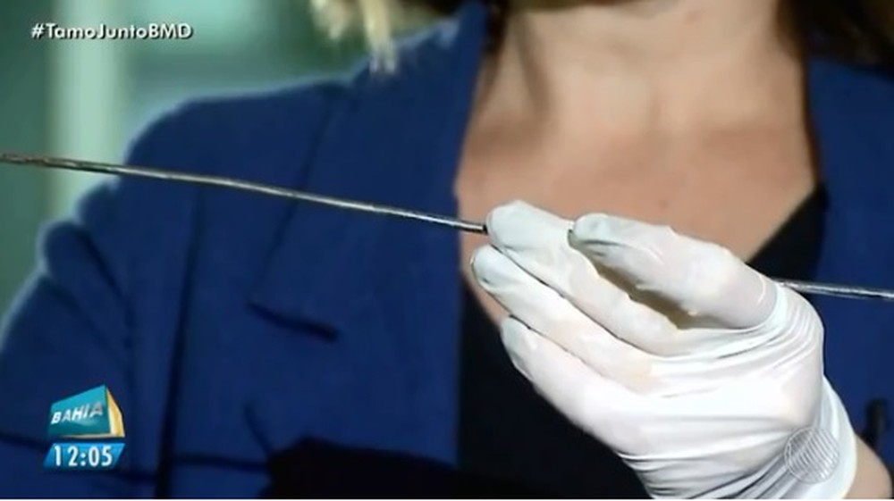 Bahia: espeto que perfurou olho de menino não deixou vítima sem visão por um milímetro; veja o vídeo