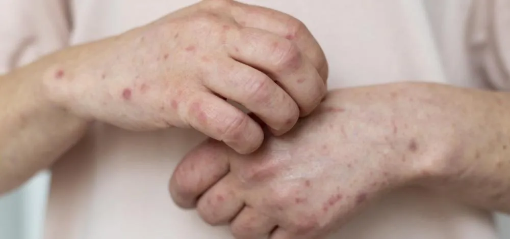 Bahia investiga novo caso suspeito de Mpox