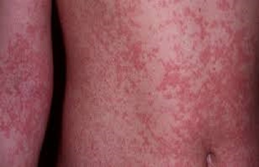 Brasil: MS registra mais de 1200 casos suspeitos de microcefalia